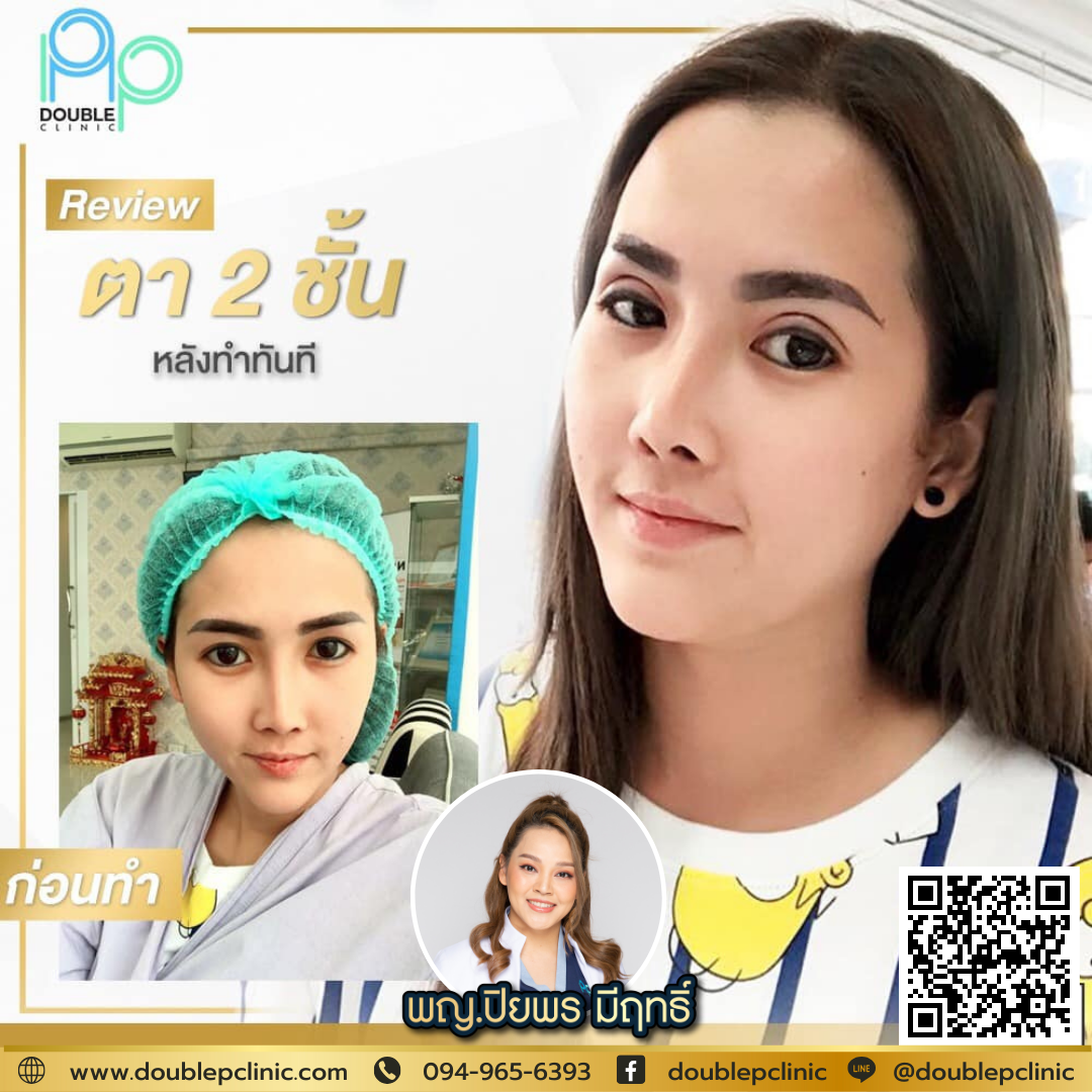 ตาสองชั้น แผลยาว
