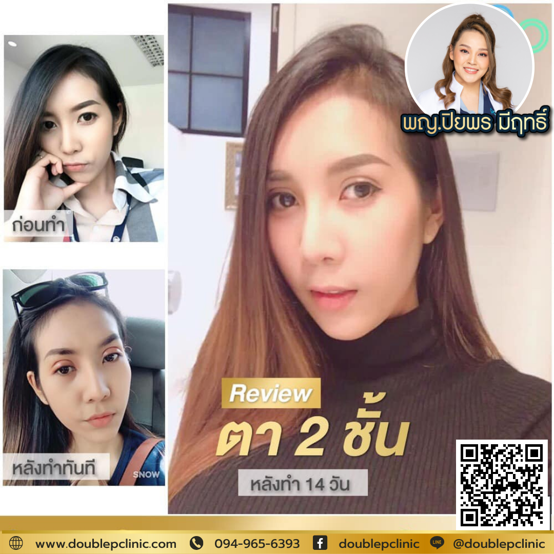 ตาสองชั้น แผลยาว