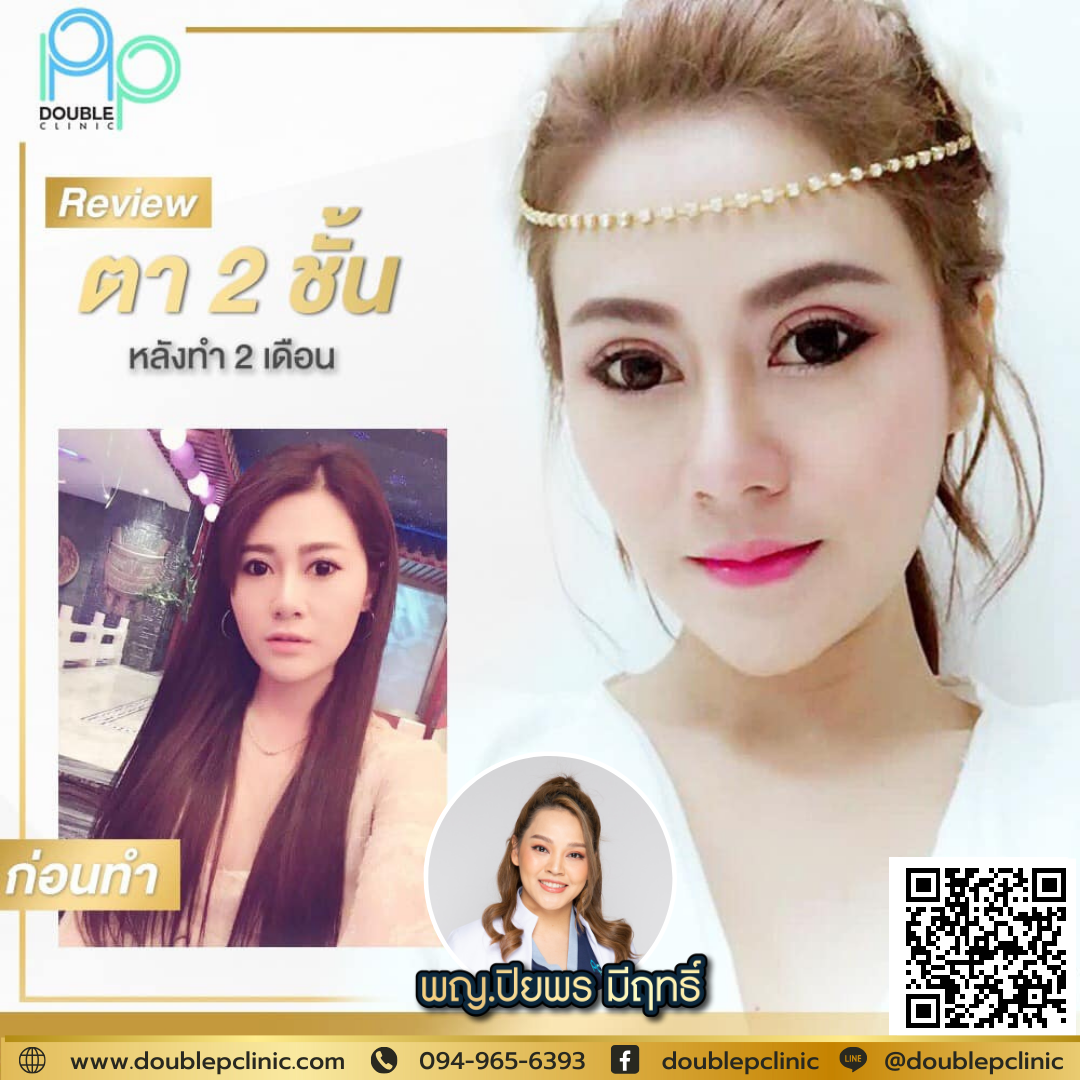 ตาสองชั้น แผลยาว