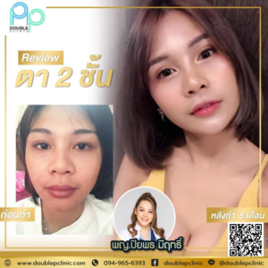 ทำตาสองชั้น แผลยาว