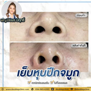 เย็บหุบปีกจมูก