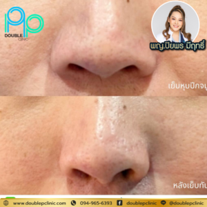 เย็บหุบปีกจมูก