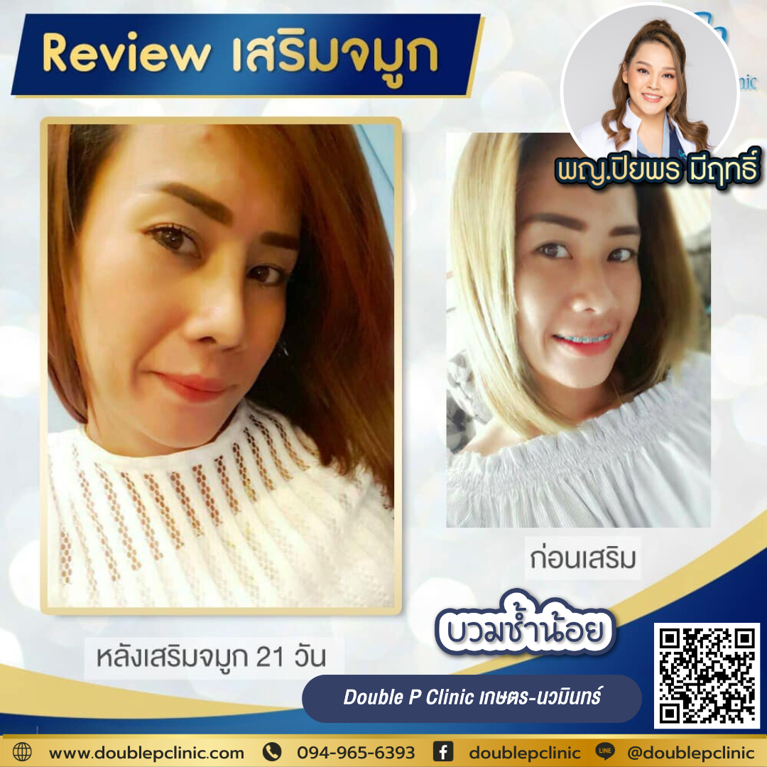 เสริมจมูก เจ็บไหม