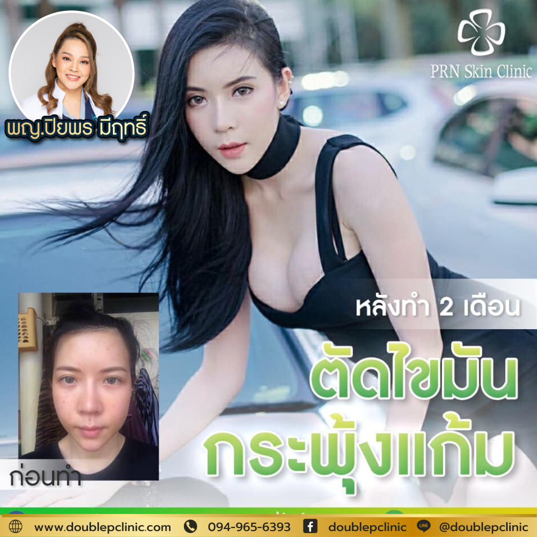ตัดไขมันกระพุ้งแก้ม คือ ตัดไขมันกระพุ้งแก้ม คือ