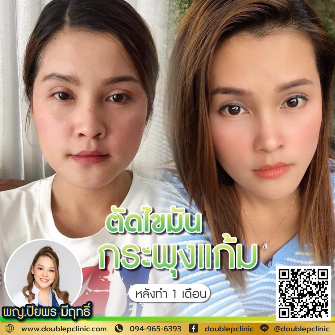 ศัลยกรรมตัดไขมันกระพุ้งแก้ม