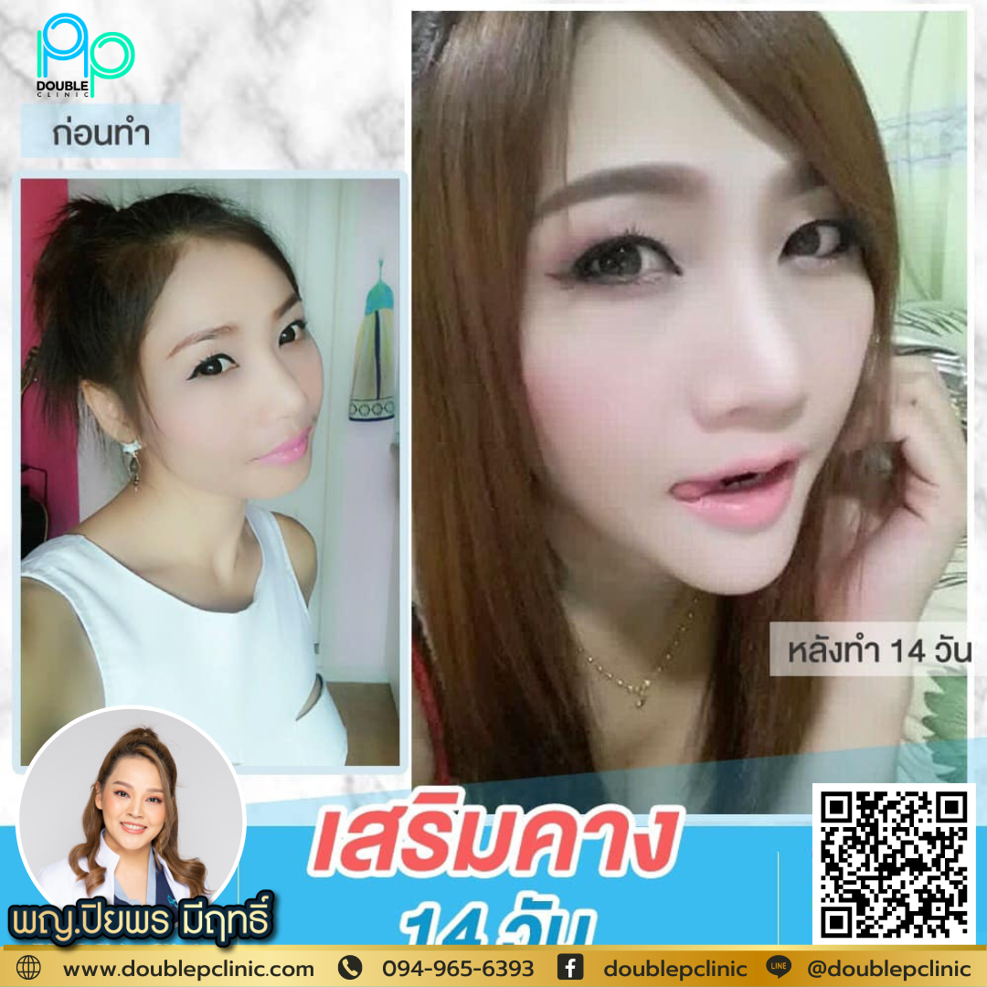 เสริมคางแผลใน คืออะไร เสริมคางแผลใน คืออะไร