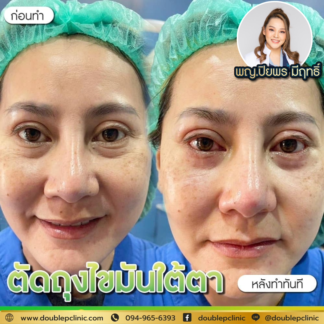 ตัดไขมันใต้ตา  แผลใน