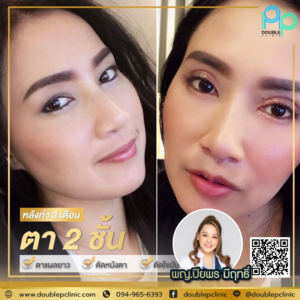 ตาสองชั้น Double P Clinic