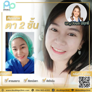 ตาสองชั้น Double P Clinic