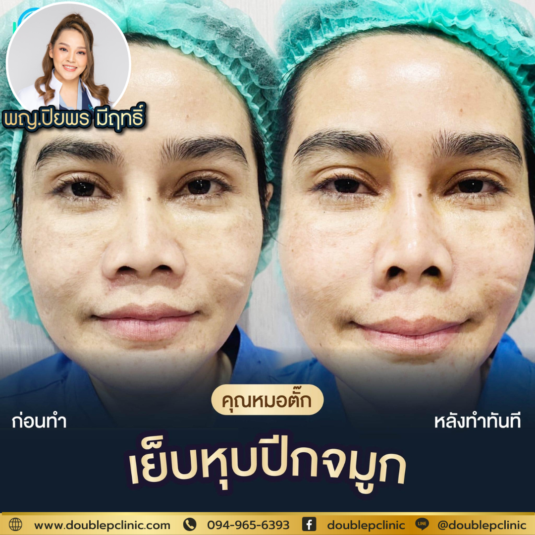 เย็บหุบปีกจมูก ช่วยอะไร เย็บหุบปีกจมูก ช่วยอะไร