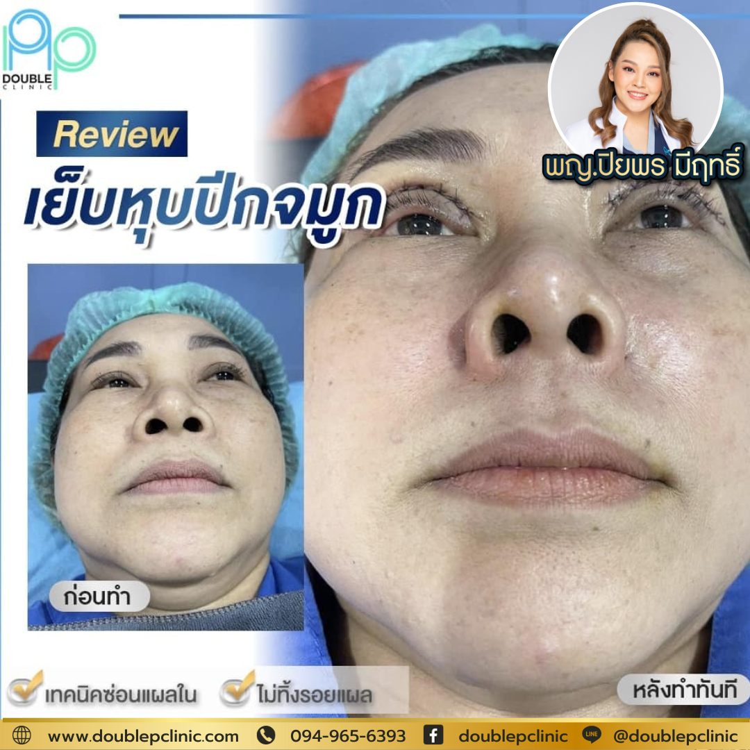 เย็บหุบปีกจมูก คือ เย็บหุบปีกจมูก คือ