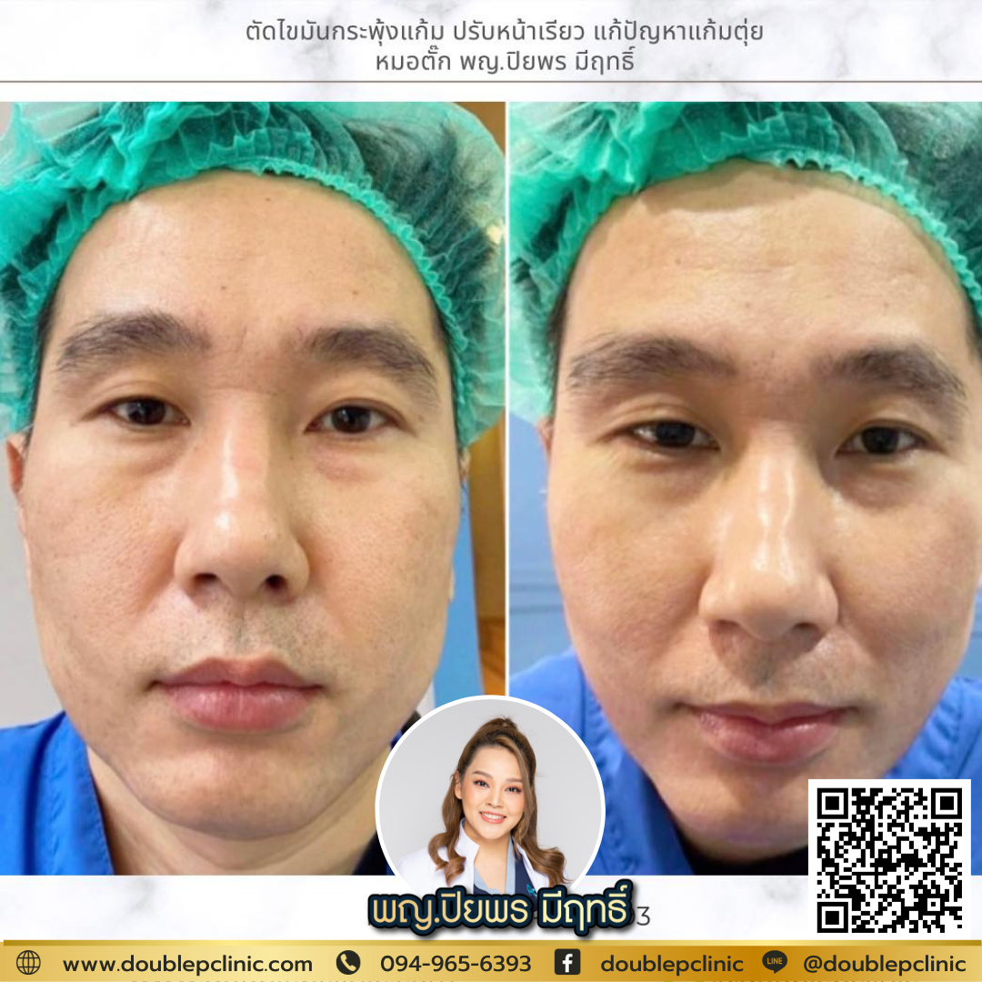 ตัดไขมันกระพุ้งแก้ม