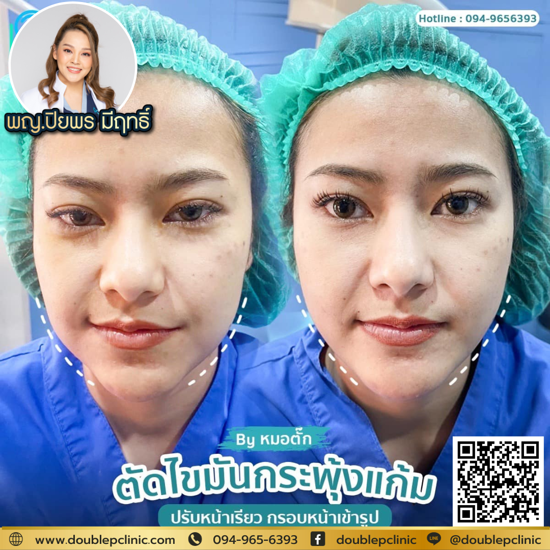 ตัดไขมันกระพุ้งแก้ม