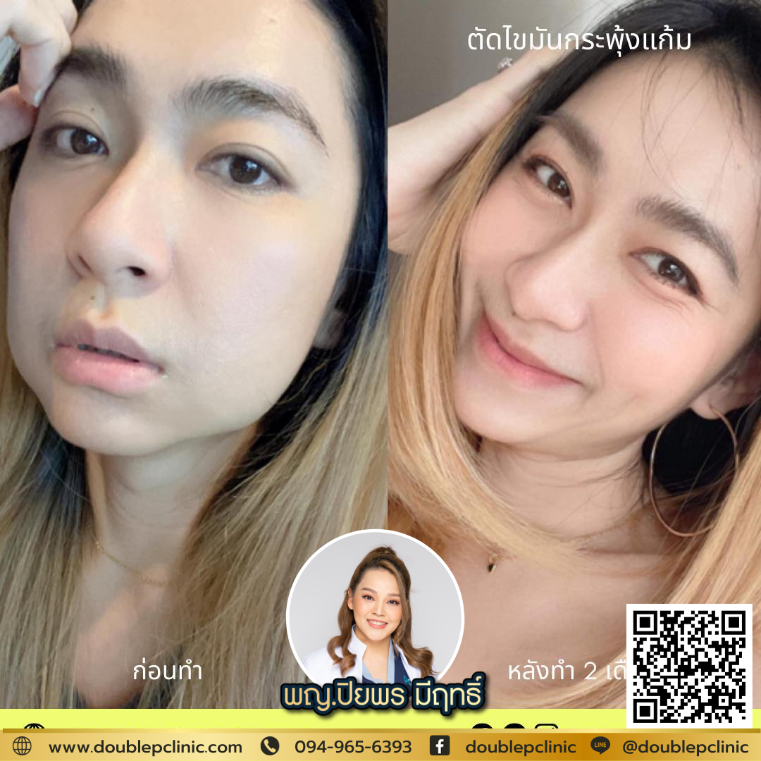ตัดไขมันกระพุ้งแก้ม