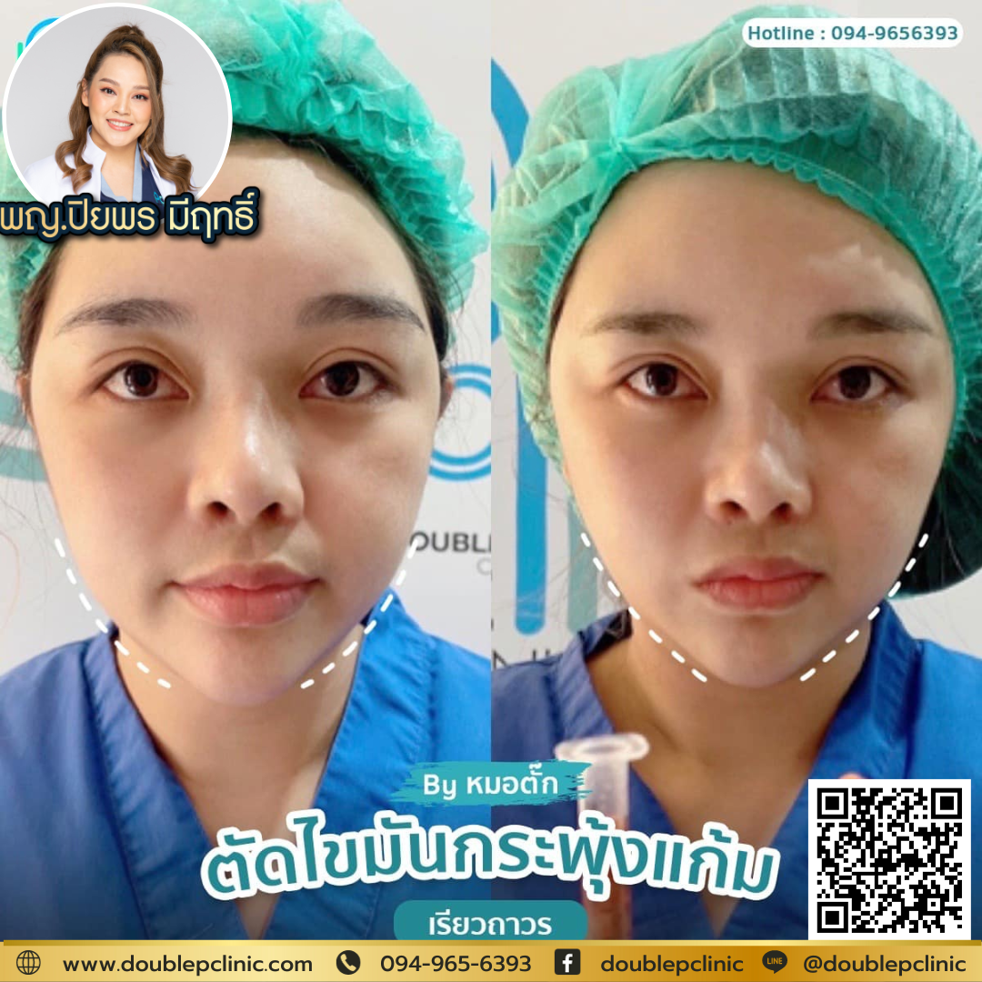 การตัดไขมันกระพุ้งแก้มมีขั้นตอนอย่างไร 