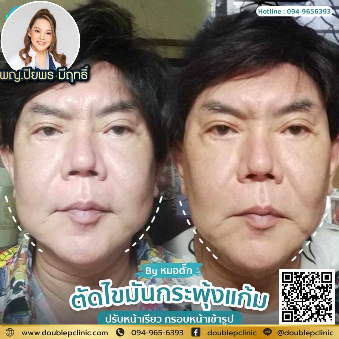 การตัดไขมันกระพุ้งแก้มมีขั้นตอนอย่างไร 