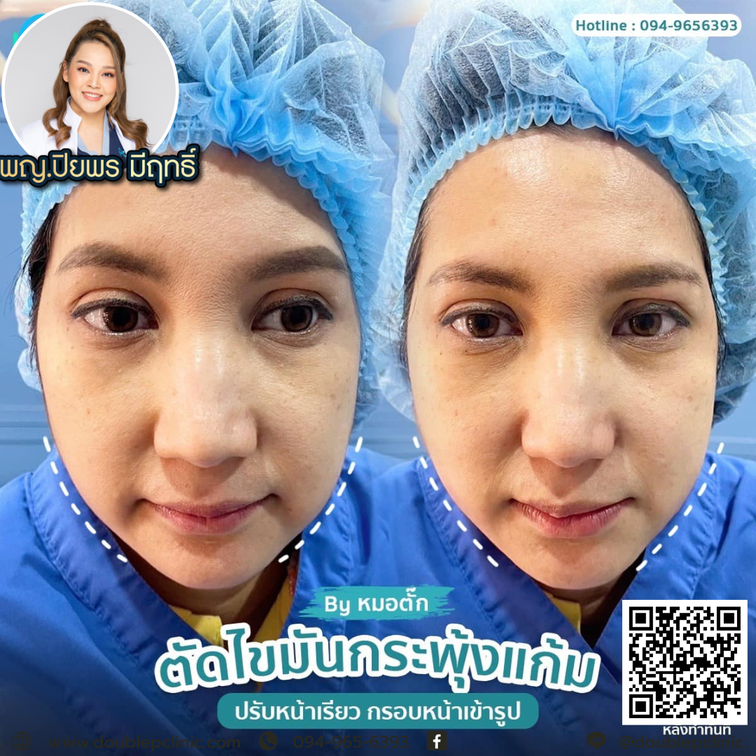 ตัดไขมันกระพุ้งแก้ม