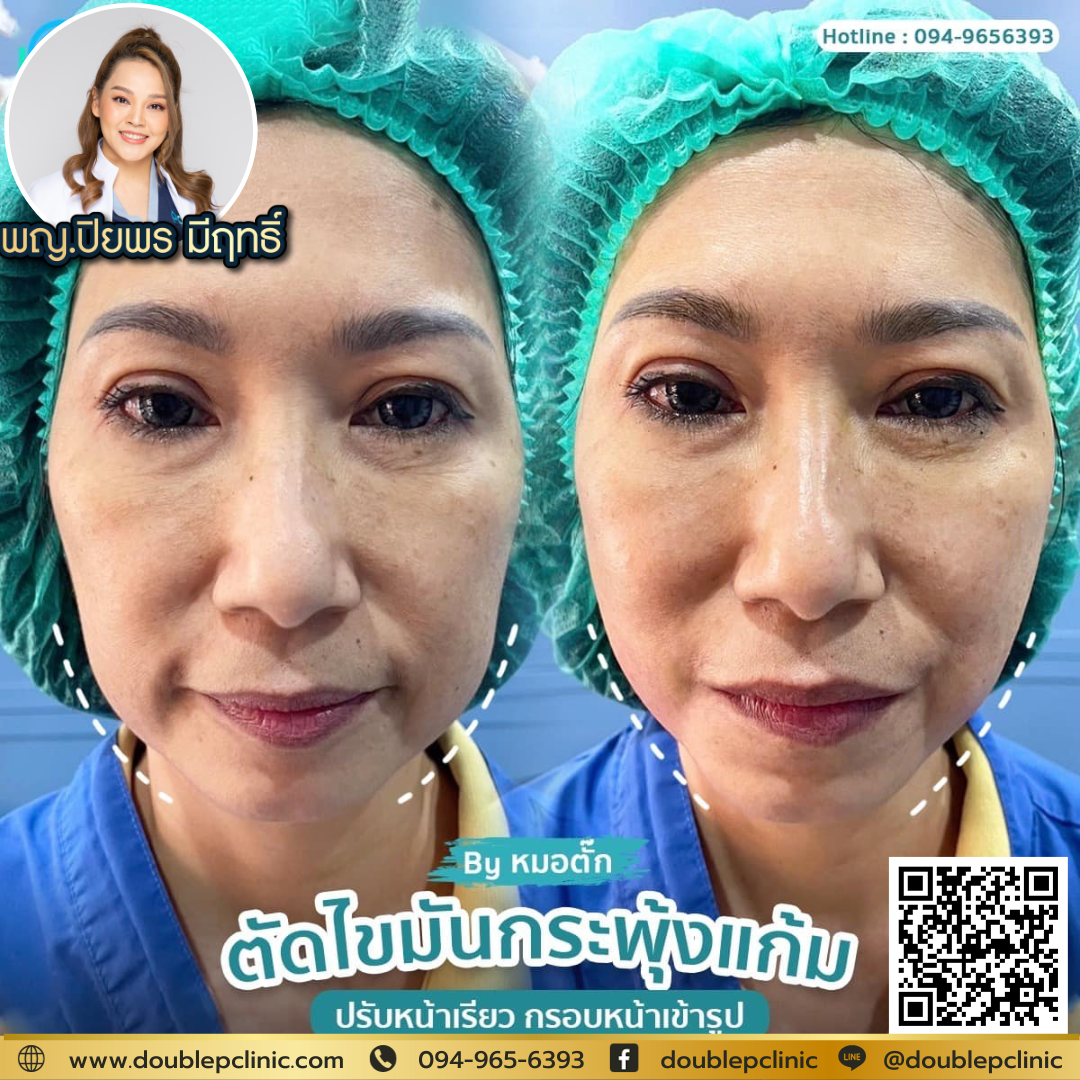 การตัดไขมันกระพุ้งแก้มมีขั้นตอนอย่างไร 