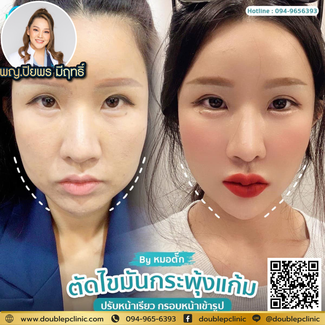 ตัดไขมันกระพุ้งแก้ม