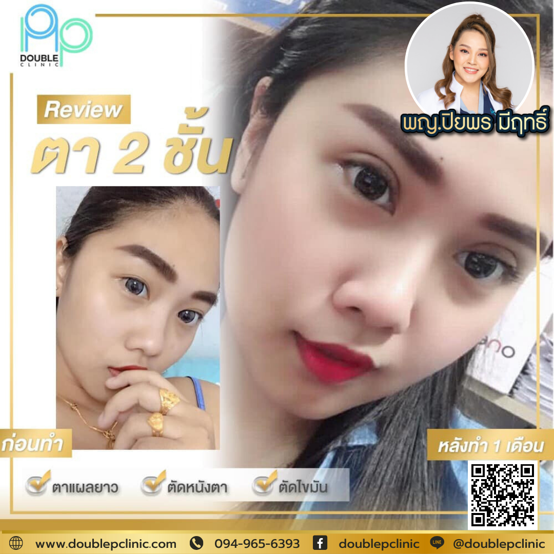 ทำตา 2 ชั้น ฉีดโบท็อกซ์ได้ไหม ทำตา 2 ชั้น ฉีดโบท็อกซ์ได้ไหม