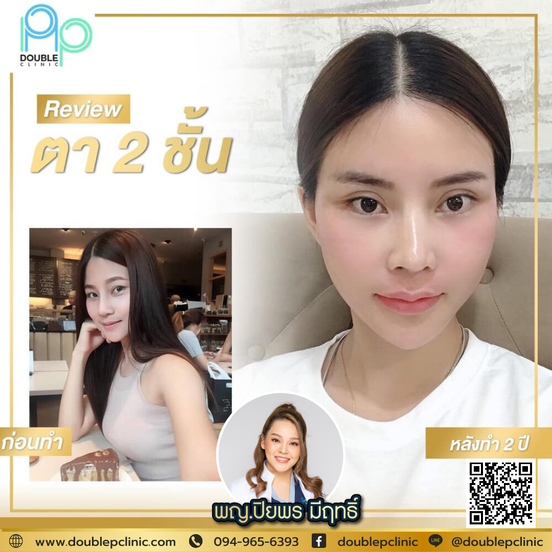 ทำตา 2 ชั้น ฉีดโบท็อกซ์ได้ไหม ทำตา 2 ชั้น ฉีดโบท็อกซ์ได้ไหม