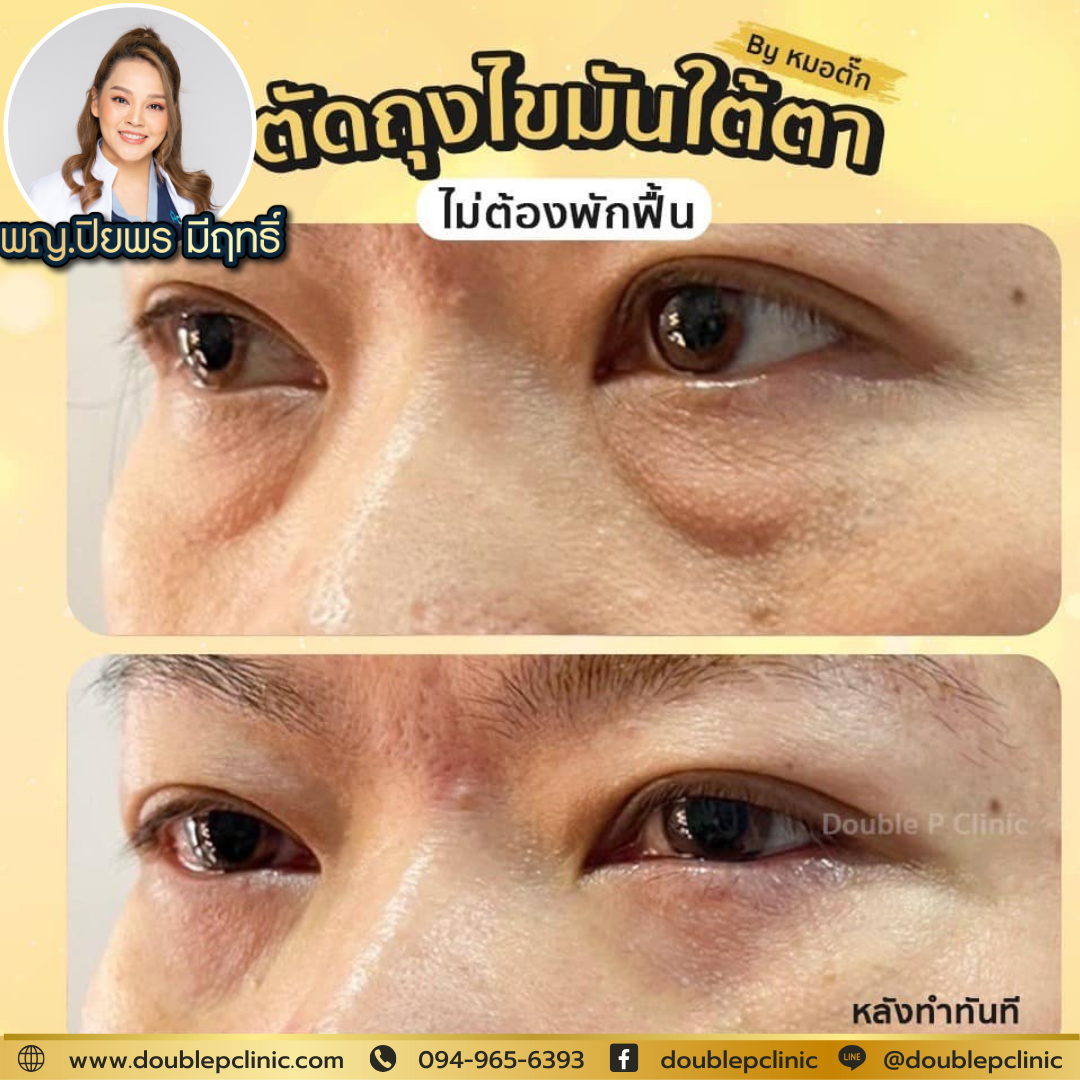 ผ่าตัดถุงไขมันใต้ตา ผ่าตัดถุงไขมันใต้ตา