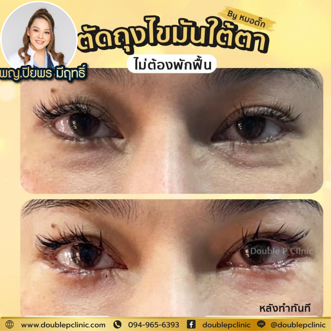 ผ่าตัดถุงไขมันใต้ตา ผ่าตัดถุงไขมันใต้ตา
