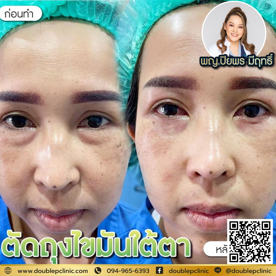 ผ่าตัดถุงไขมันใต้ตาเจ็บไหม ผ่าตัดถุงไขมันใต้ตาเจ็บไหม