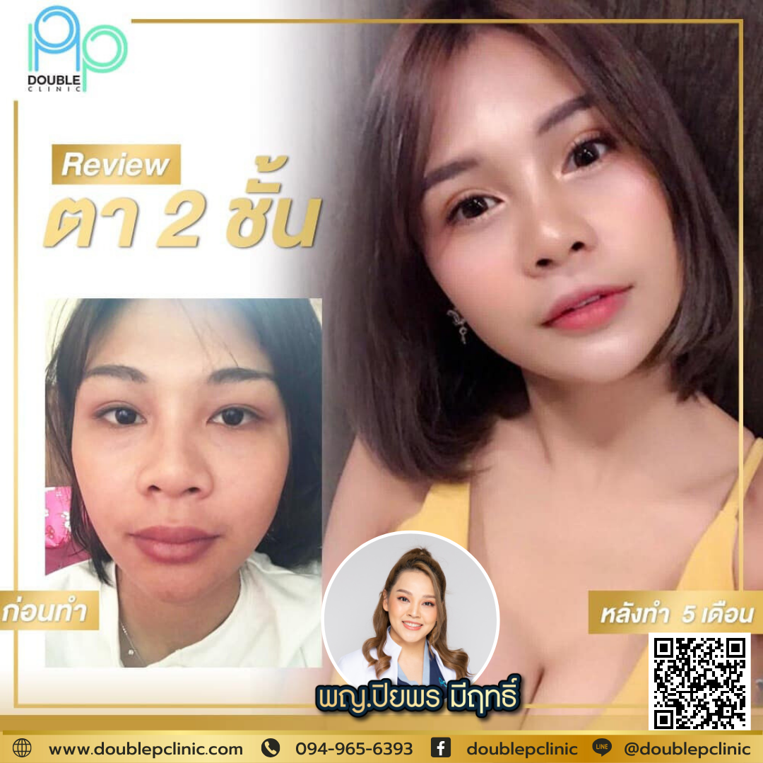 ตาสองชั้น กรีดสั้น กรีดยาว ต่างกันอย่างไร ? ตาสองชั้น กรีดสั้น กรีดยาว ต่างกันอย่างไร ?