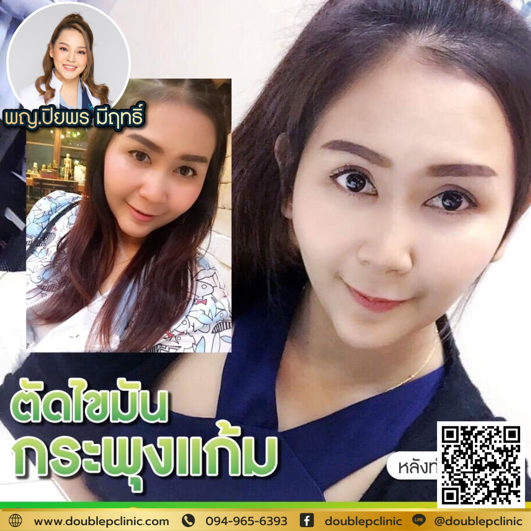 ตัดไขมันกระพุ้งแก้ม