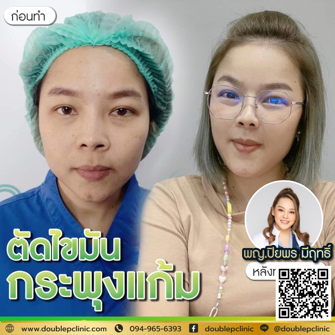 ตัดไขมันกระพุ้งแก้ม