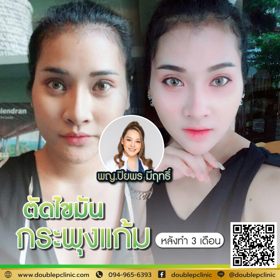 ประโยชน์ของการตัดไขมันกระพุ้งแก้ม ประโยชน์ของการตัดไขมันกระพุ้งแก้ม