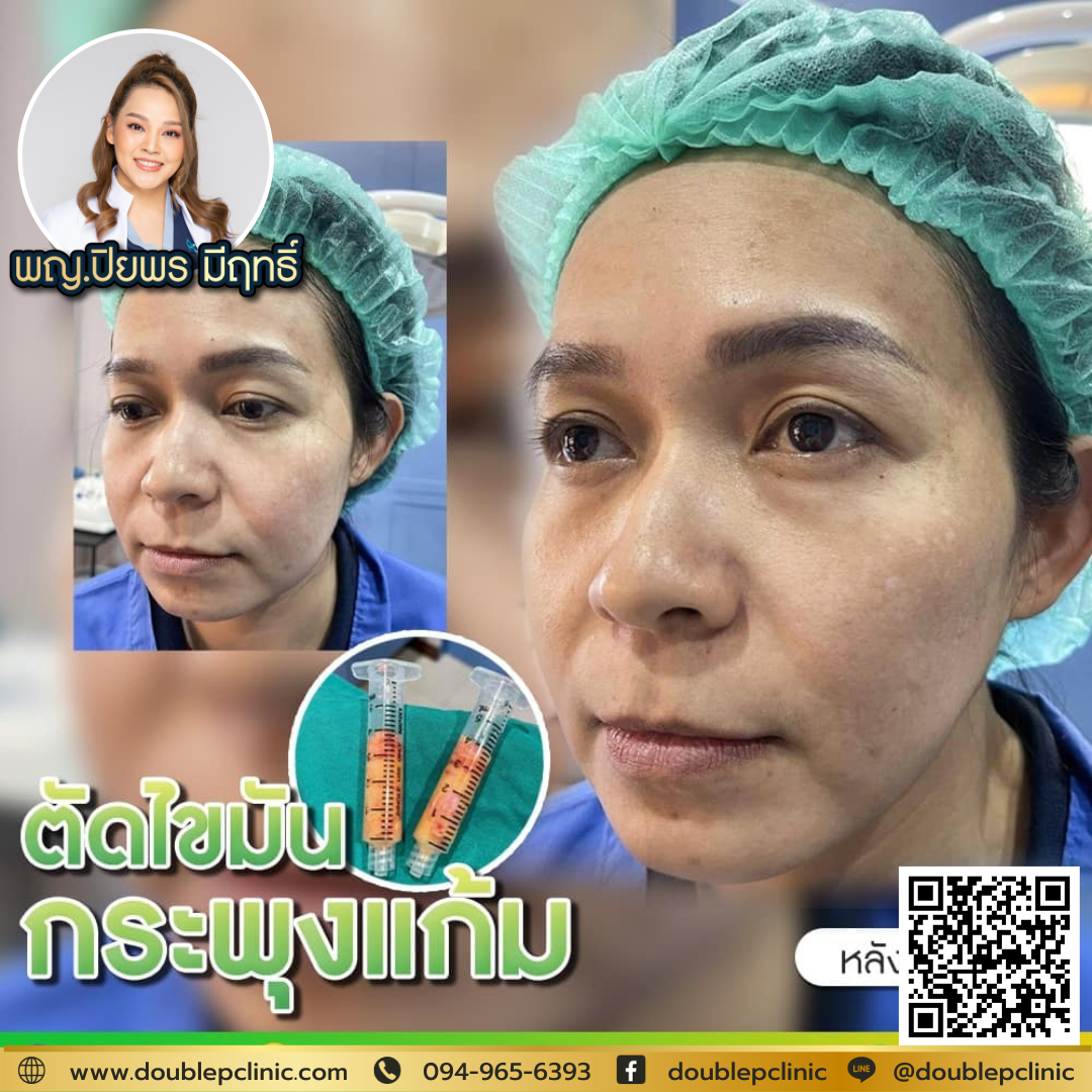 ตัดไขมันกระพุ้งแก้ม