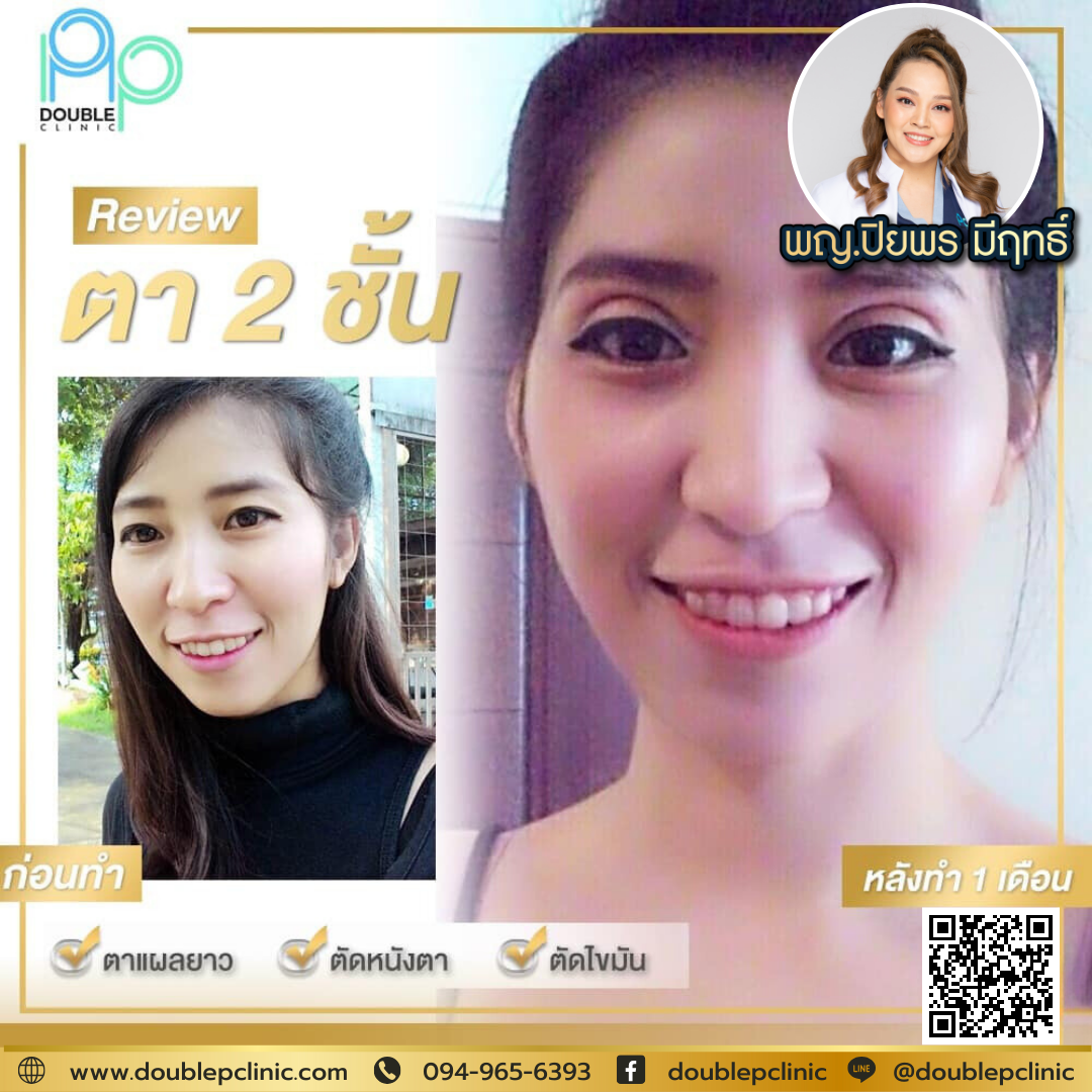ทำตาสองชั้น แก้ กล้ามเนื้อตาอ่อนแรง 