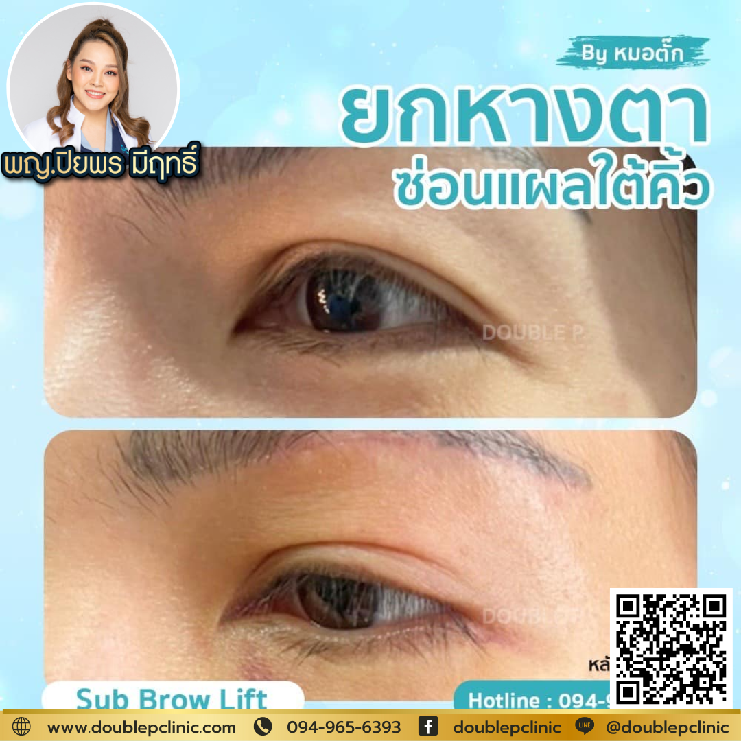 Sub Brow Lift รีวิว 