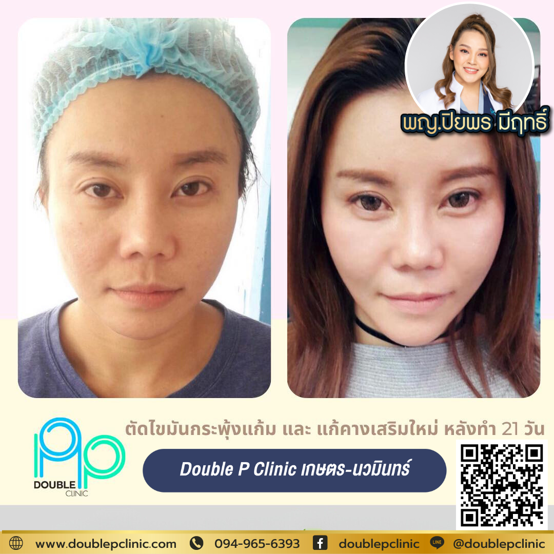 วิธีดูแลหลังเสริมคาง แผลใน วิธีดูแลหลังเสริมคาง แผลใน