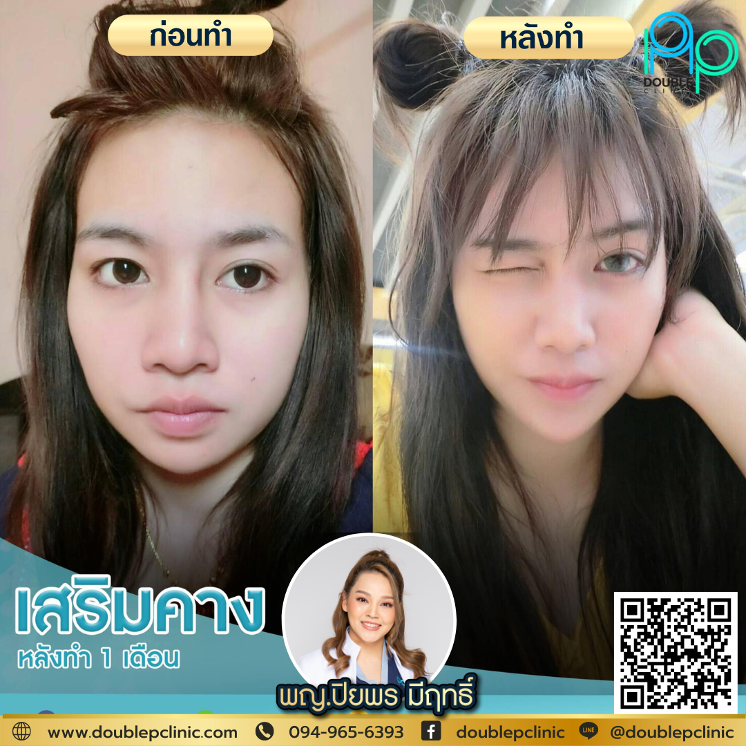 เสริมคาง Chin Augmentation เสริมคาง Chin Augmentation