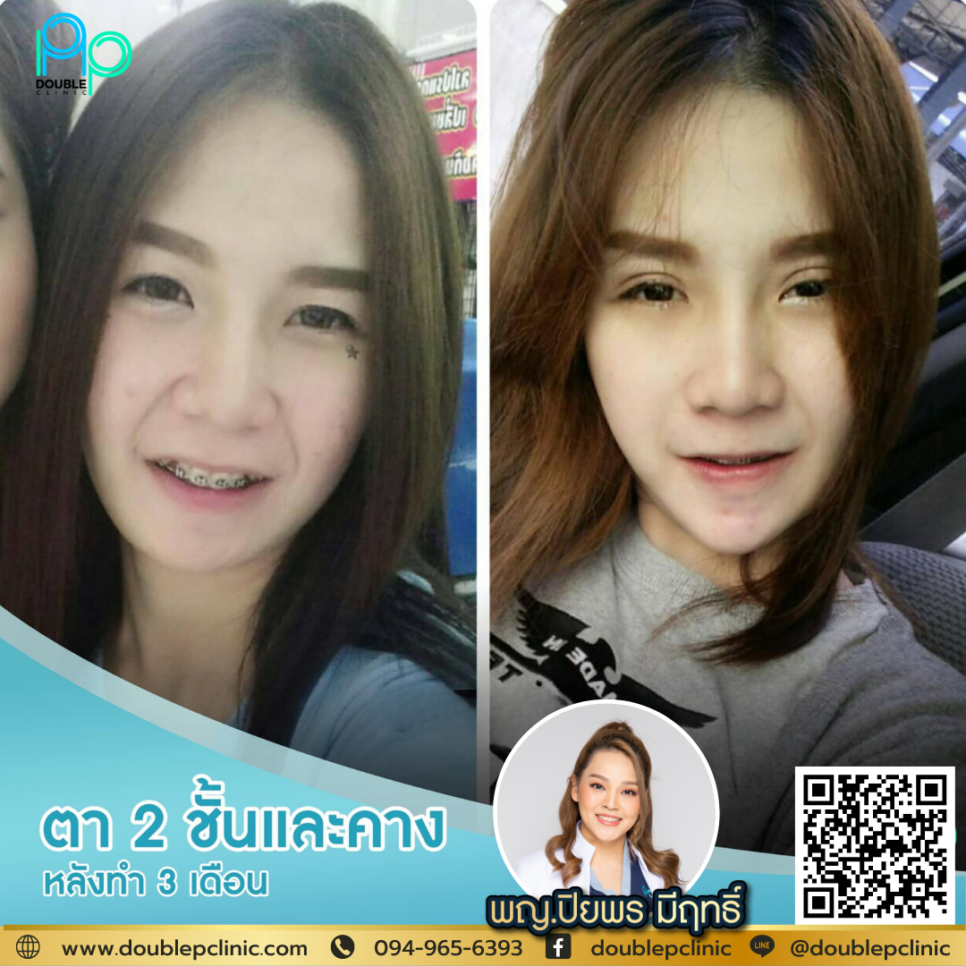 เสริมคางแผลใน กินอะไรได้บ้าง เสริมคางแผลใน กินอะไรได้บ้าง