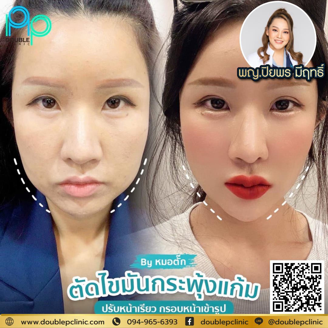 ผ่าตัดไขมันกระพุ้งแก้ม แก้ปัญหาหน้ากลม