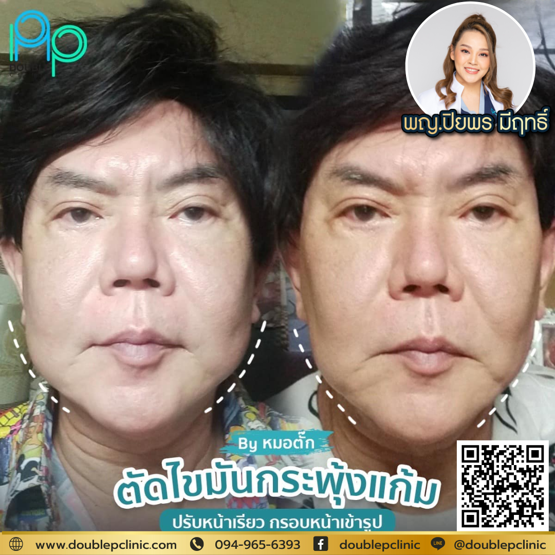 ผ่าตัดไขมันกระพุ้งแก้ม แก้ปัญหาหน้ากลม