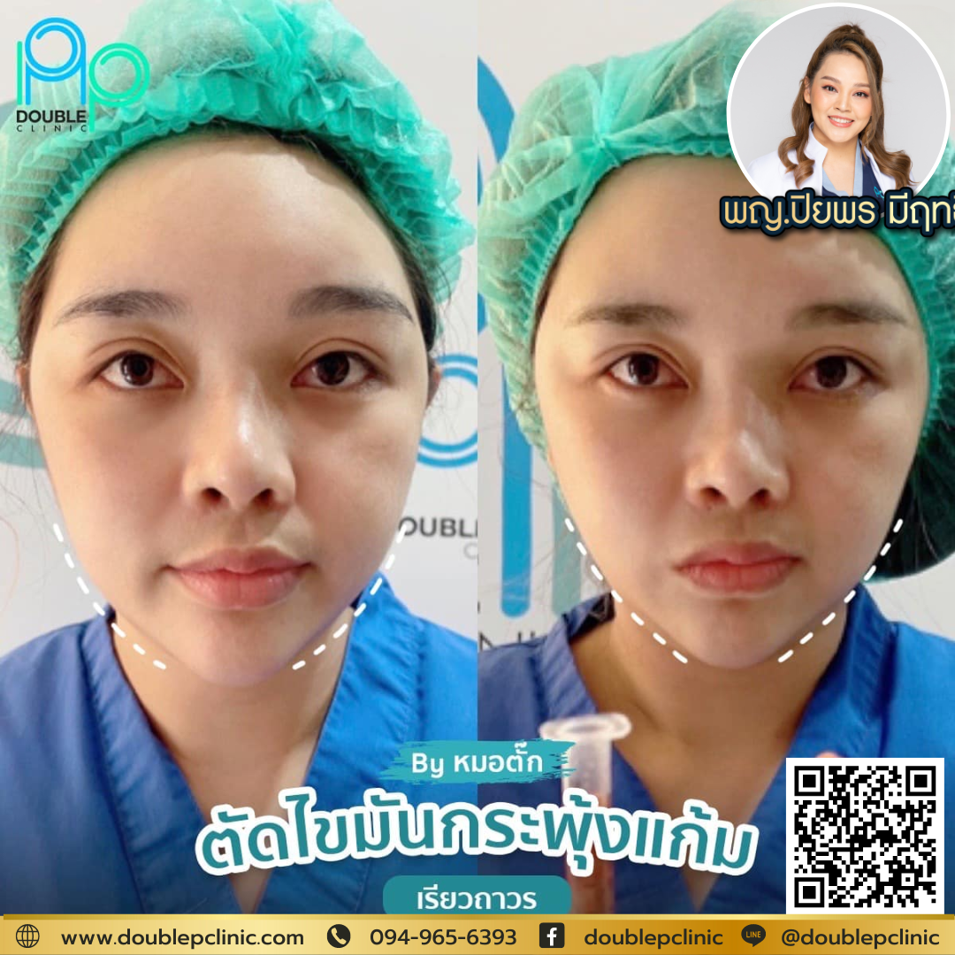 ผ่าตัดไขมันกระพุ้งแก้ม แก้ปัญหาหน้ากลม