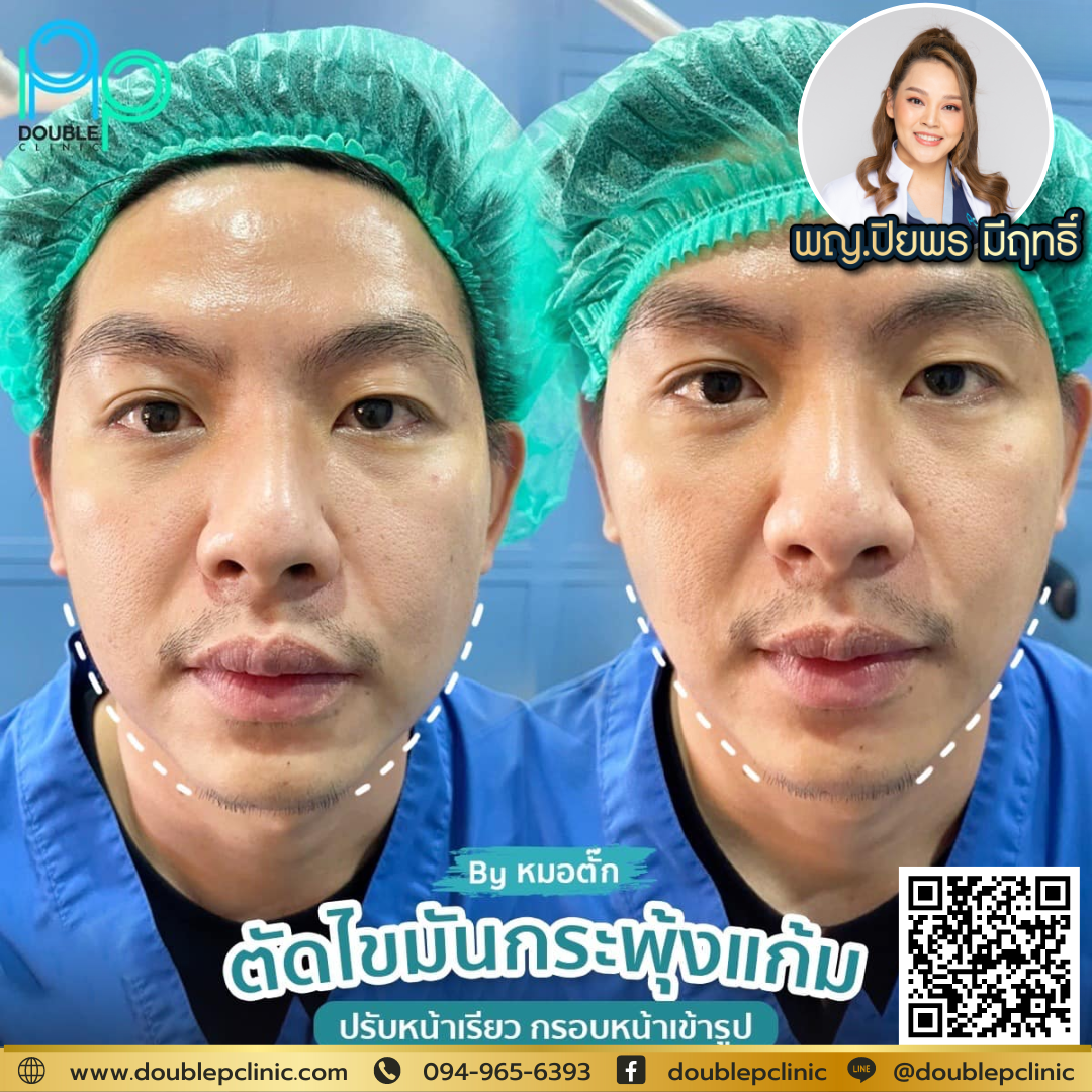 ตัดไขมันกระพุ้งแก้ม