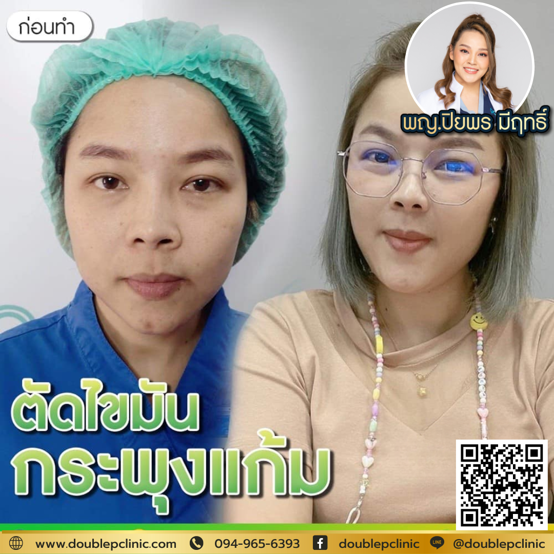 ตัดไขมันกกระพุ้งแก้ม กี่เดือน เห็นผล ตัดไขมันกกระพุ้งแก้ม กี่เดือน เห็นผล