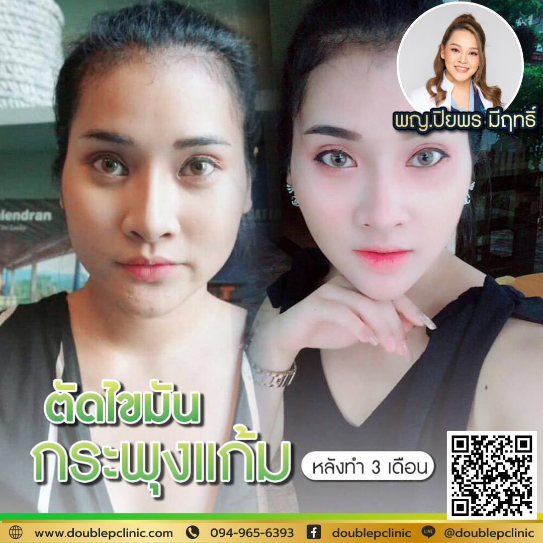 ตัดไขมันกระพุ้งแก้ม