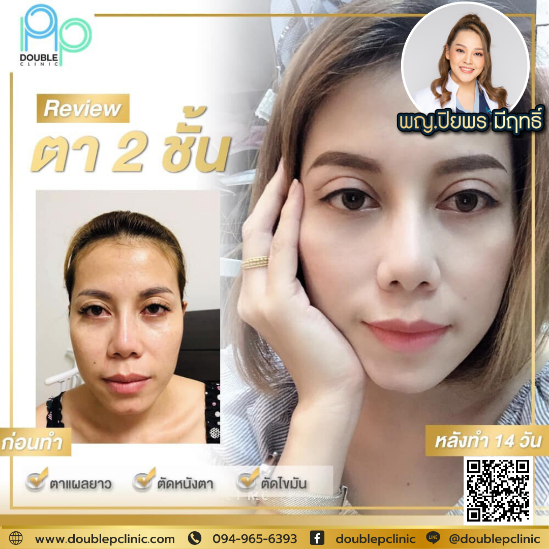 ตาสองชั้น แบบไหนสวย