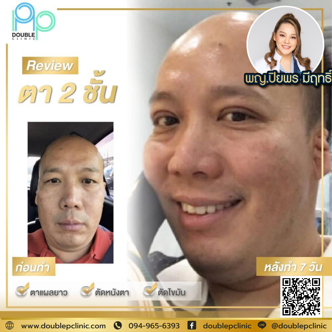 ตาสองชั้นหลบใน คืออะไร ตาสองชั้นหลบใน คืออะไร