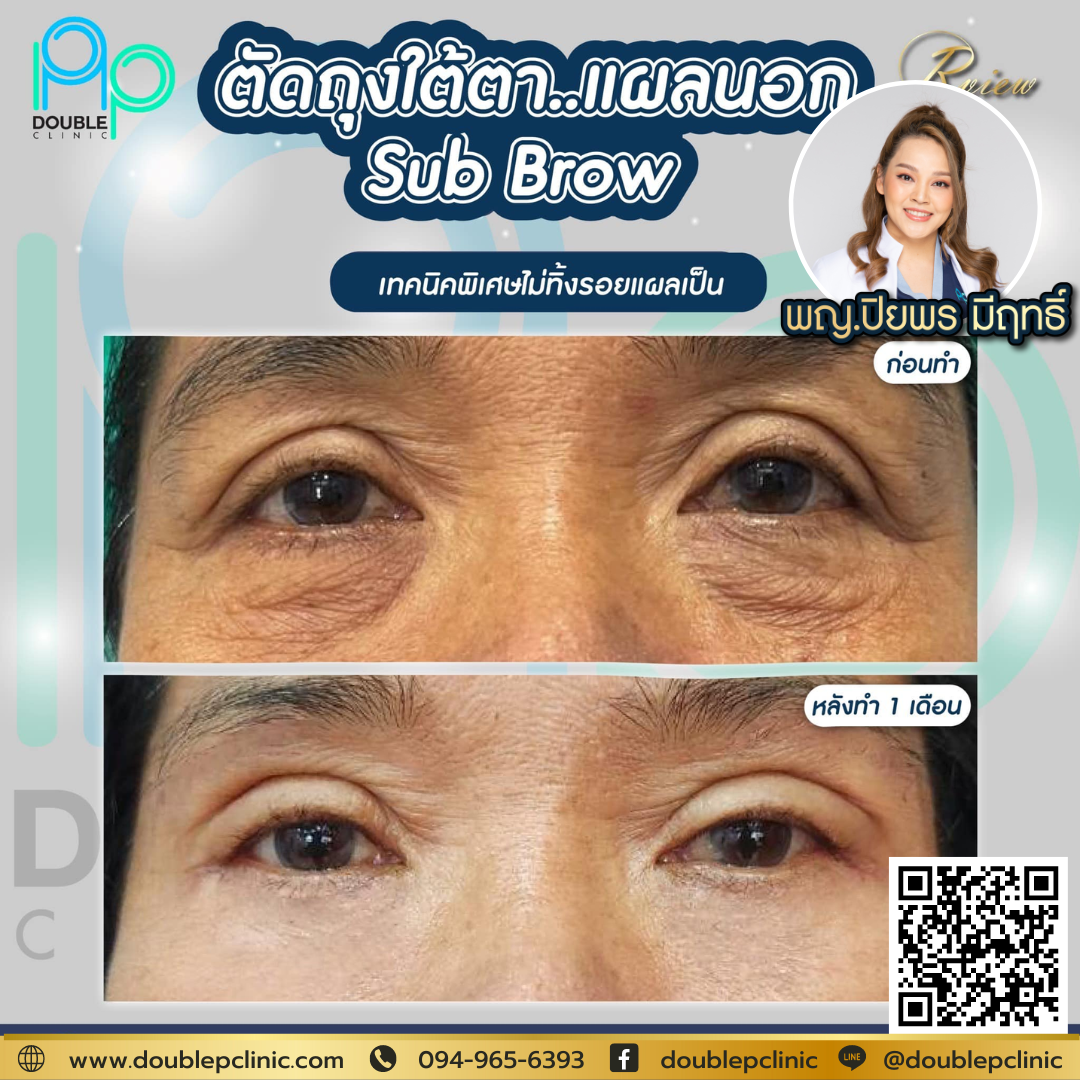 หนังตาตก หางตาตก เกิดจากสาเหตุใด หนังตาตก หางตาตก เกิดจากสาเหตุใด