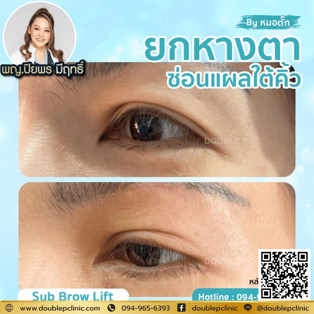 หนังตาตก หนังตาตก