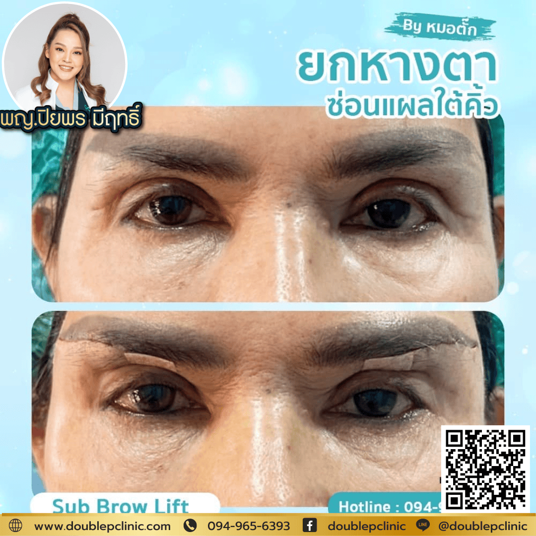 หนังตาตก หนังตาตก