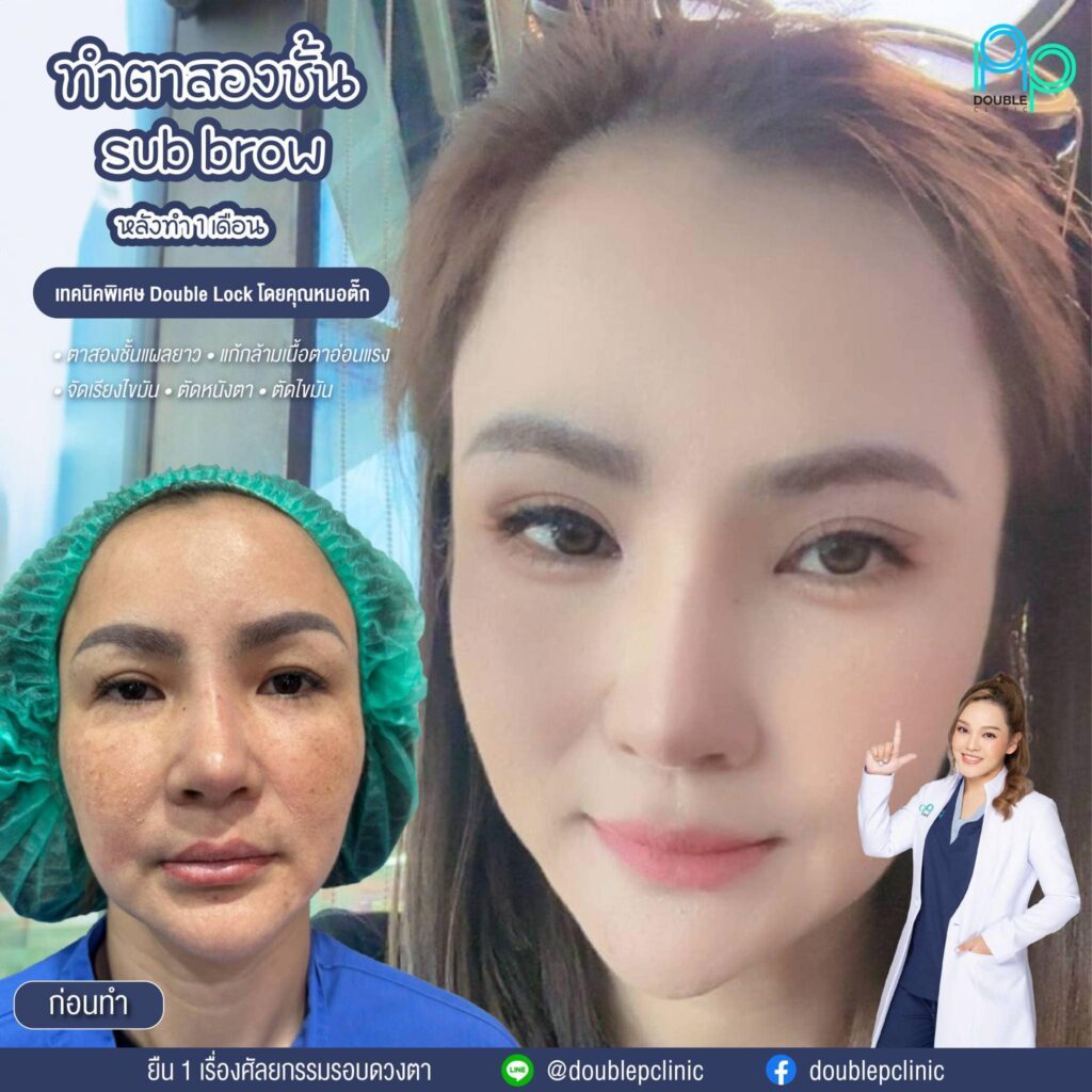 หนังตาตก หางตาตก เกิดจากสาเหตุใด หนังตาตก หางตาตก เกิดจากสาเหตุใด